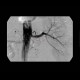 Stenosis of renal artery, stent: AG - Angiography